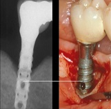 Biologic complications - Peri-implantitis